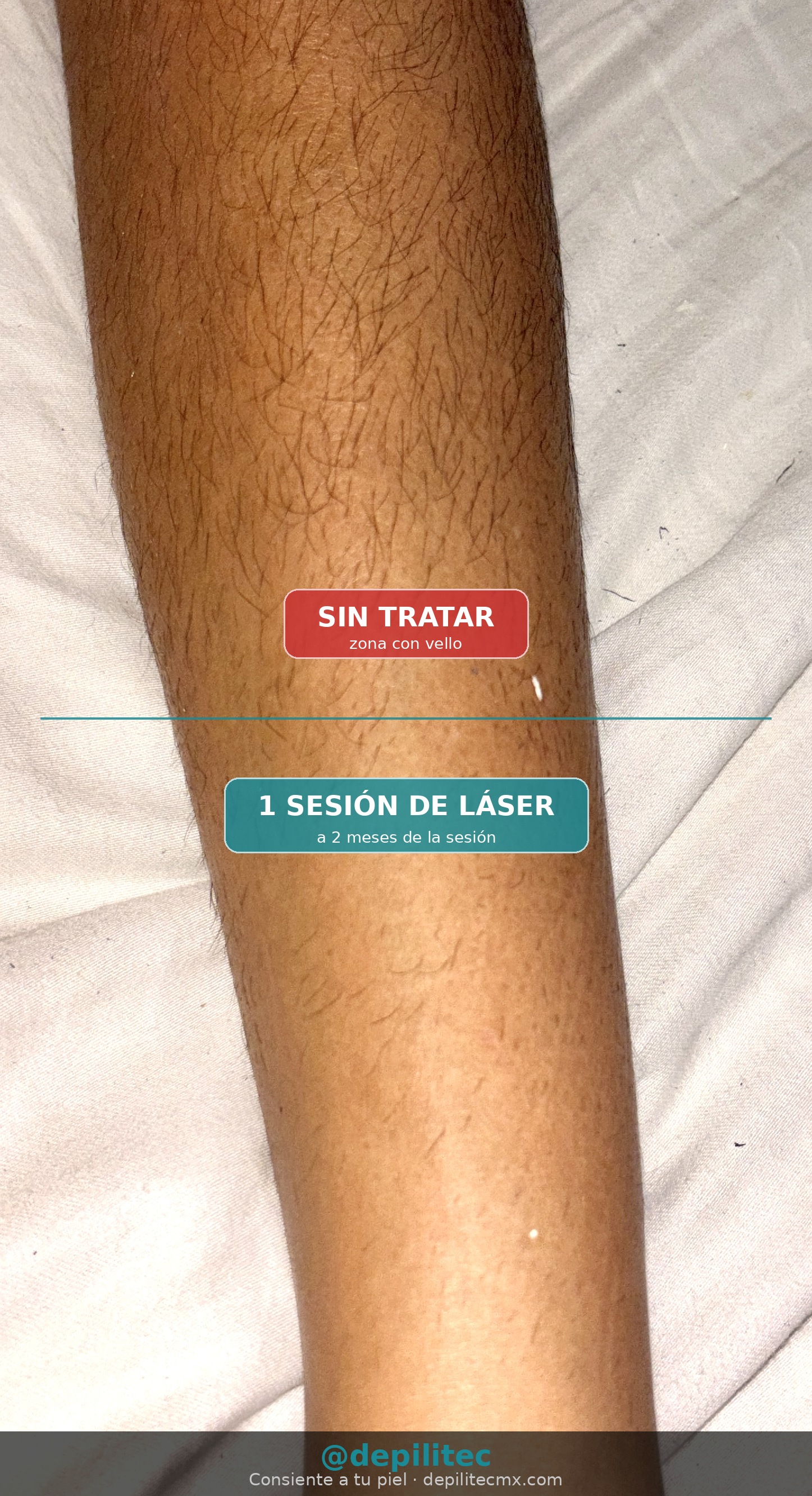 Resultado depilación láser piernas - 1 sesión a 2 meses