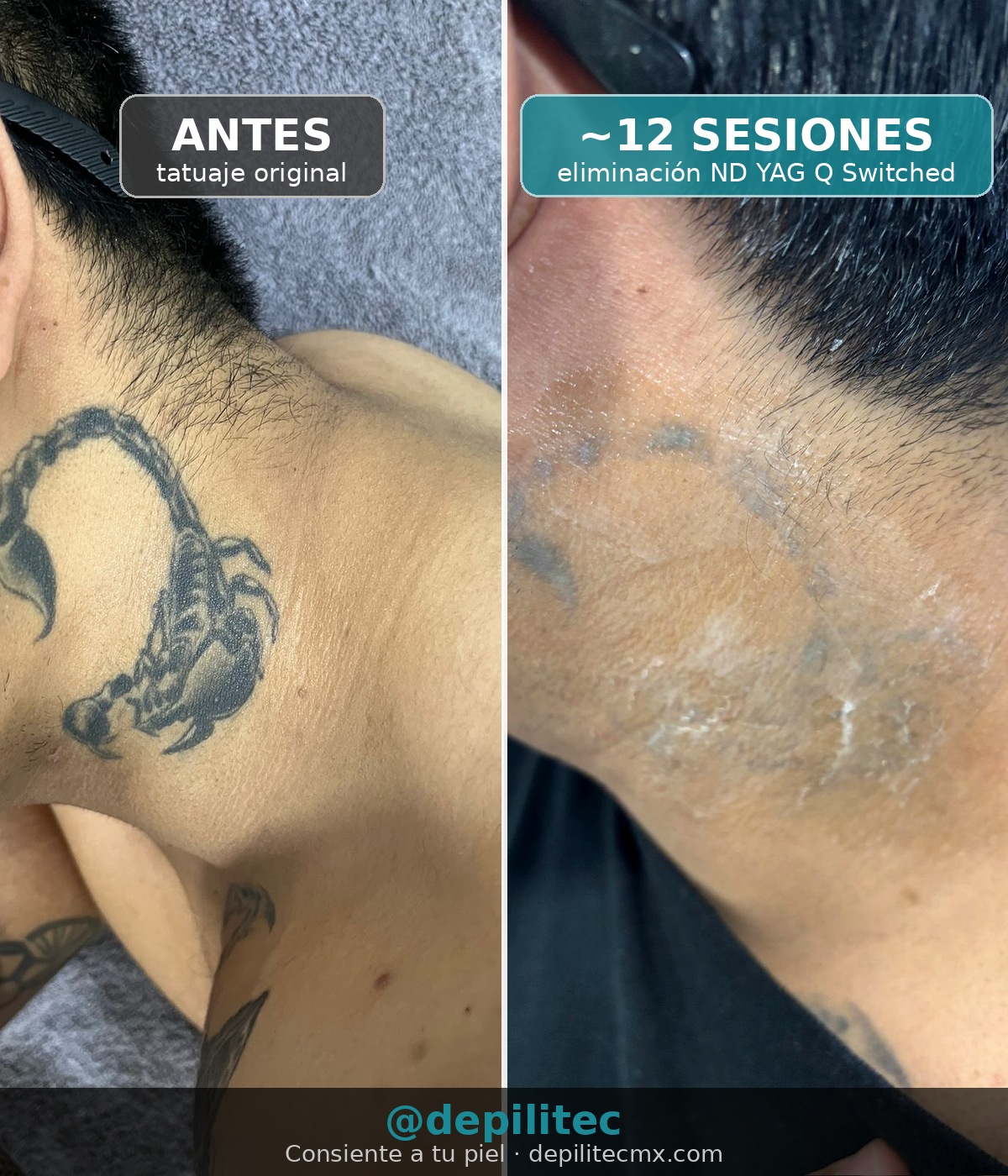 Eliminación de tatuaje con ND YAG Q Switched - antes y después ~12 sesiones